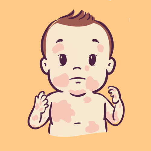 Koemelkallergie komt vaak voor bij baby's